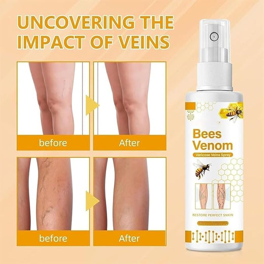 Bee Venom Varicose Veins Care Spray (Pack of 2) – Refreshing Leg Comfort Spray for Daily Use | Buy 1 Get 1 Free